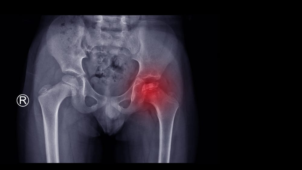 An x-ray of a patient's hip